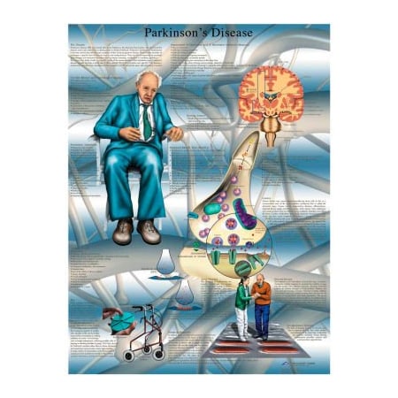 Fabrication Enterprises 3B Anatomical Chart - Parkinson's Disease, Laminated 12-4616L